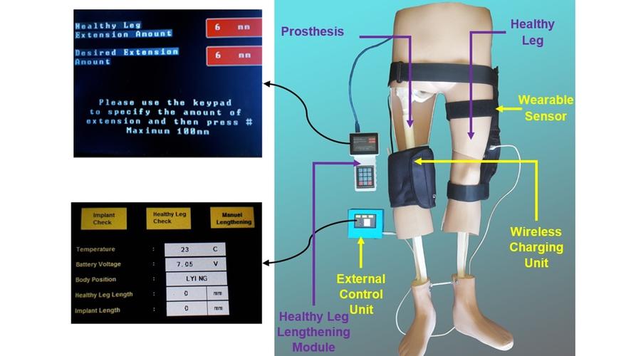 Türk akademisyenler, kemik kanseri tedavisi için tümör protezi geliştirdi Türk akademisyenler, kemik kanseri tedavisi için tümör protezi geliştirdi