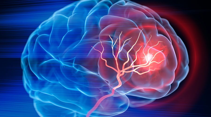 Prof. Dr. Semih Giray: 10 Adımda İnmeden Korunmanın Yolları Prof. Dr. Semih Giray: 10 Adımda İnmeden Korunmanın Yolları